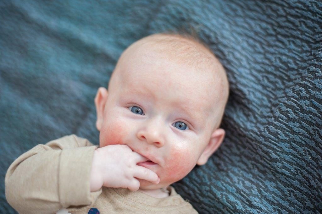 Bebeklerde Atopik Dermatit Nedir ?