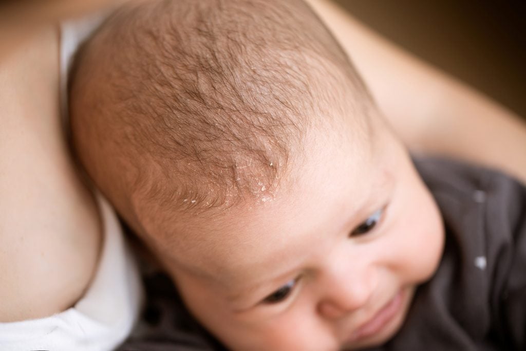 Bebeklerin Kafasındaki Kepek Nasıl Geçer?